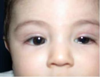  Bebeklerde ve Çocuklarda Göz  Sulanması (Doğumsal Dakriostenoz) 